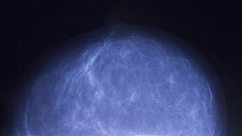 De medisinske bildene av bryster med kreft gir mange av datapunktene som skal inn i den digitale modellen som brukes i simuleringen.